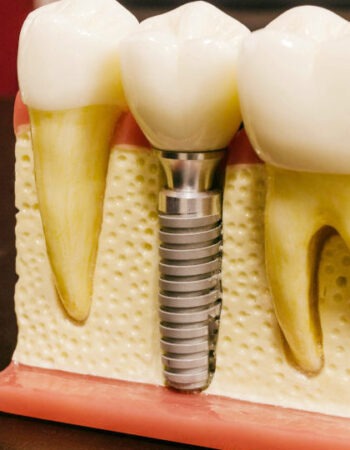 Prótese Dentária
