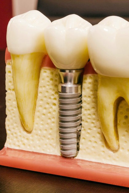 Prótese Dentária